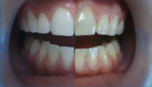  Teeth whitening before and after