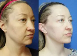 подтяжка лица турция