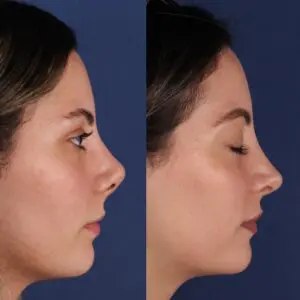 пластика носа турция