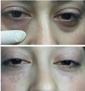 блефаропластика турция