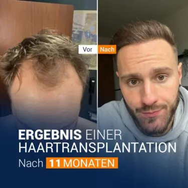 Greffe de cheveux