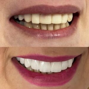 Smile transformation: teeth in Turkey before and after