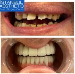 Имплантация зубов в Турции до и после