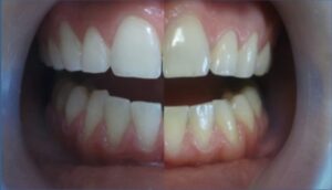Відбілювання зубів до і після