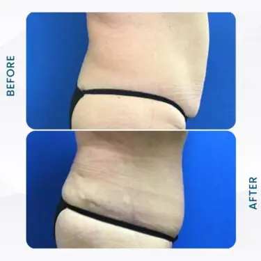 Liposuccion