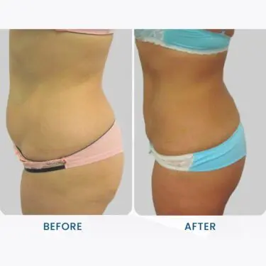 Liposuccion