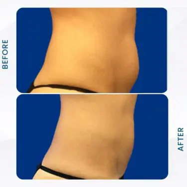 Liposuccion