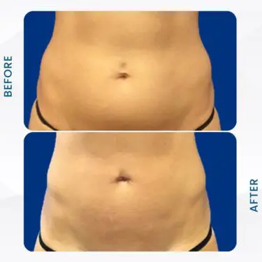 Liposuccion