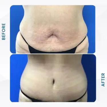 Liposuccion
