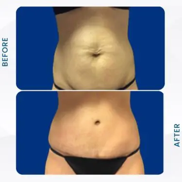 Liposuccion