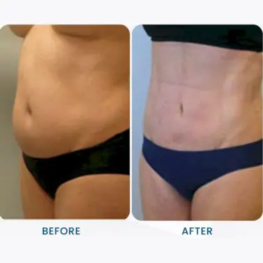 Liposuccion