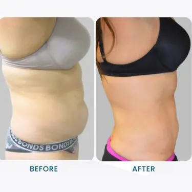 Liposuccion