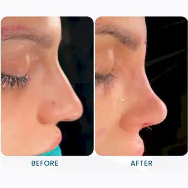 Rhinoplastie