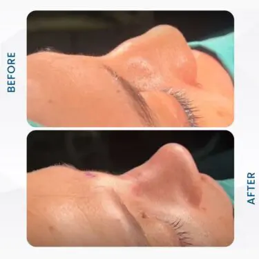 Rhinoplastie