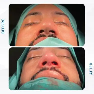 Rhinoplastie