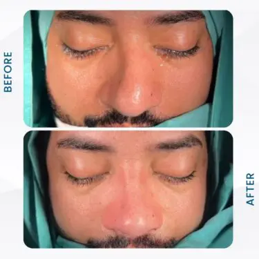 Rhinoplastie