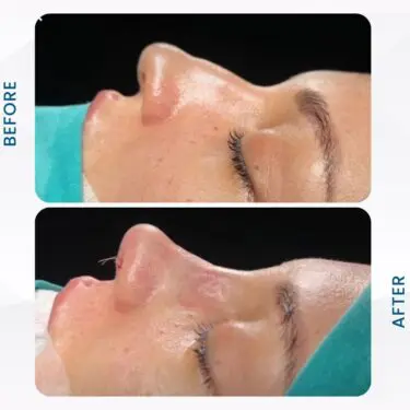 Rhinoplastie