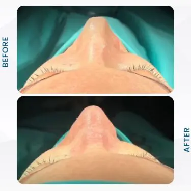 Rhinoplastie