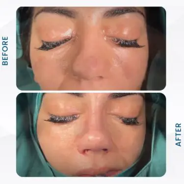 Rhinoplastie