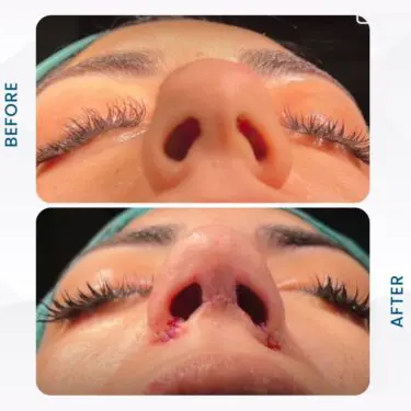 Rhinoplastie