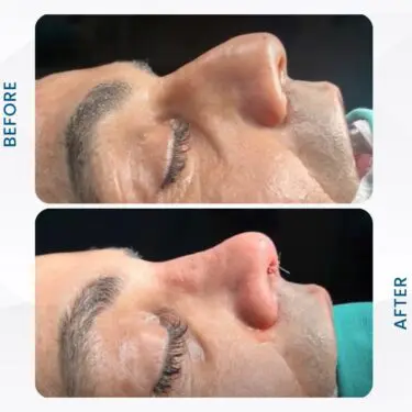 Rhinoplastie