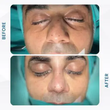 Rhinoplastie