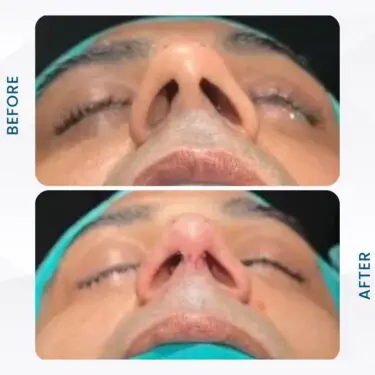 Rhinoplastie