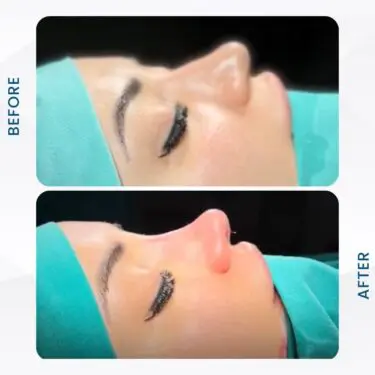 Rhinoplastie