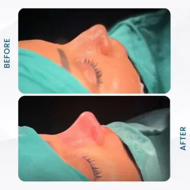 Rhinoplastie