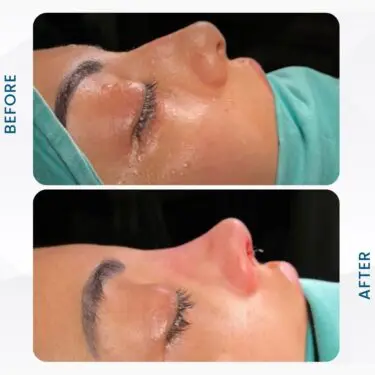 Rhinoplastie