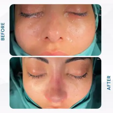 Rhinoplastie