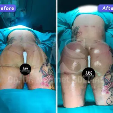 Brazilian Butt Lift (BBL)