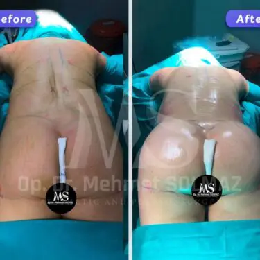 Brazilian Butt Lift (BBL)