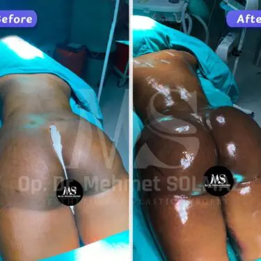 Brazilian Butt Lift (BBL)