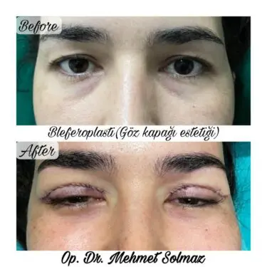 Blepharoplastik