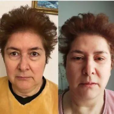 Blepharoplastik