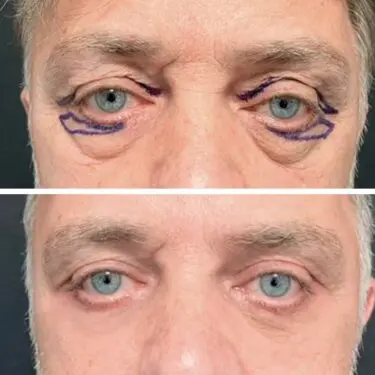 Blepharoplastik