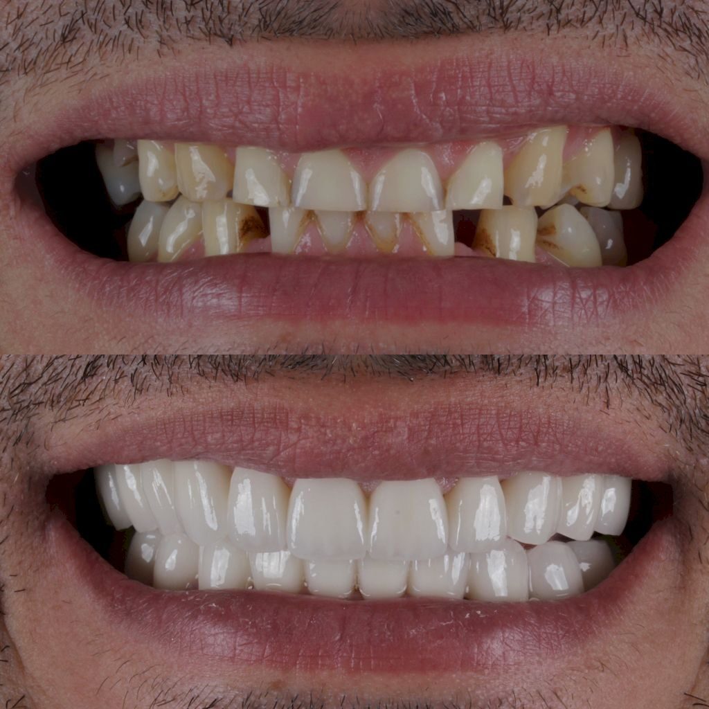 Имплантация зубов в Турции, Анталия