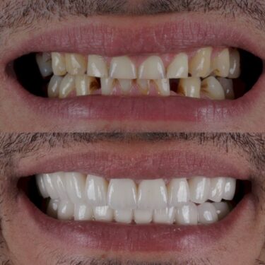 Dental Implants in Turkey, Antalya