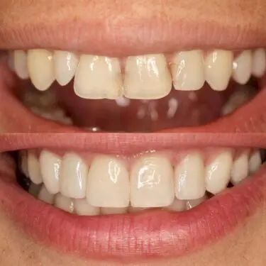 Veneers in der Türkei, Antalya