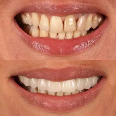 Veneers in Turkey, Antalya