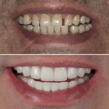 Dental Implants in Turkey, Antalya