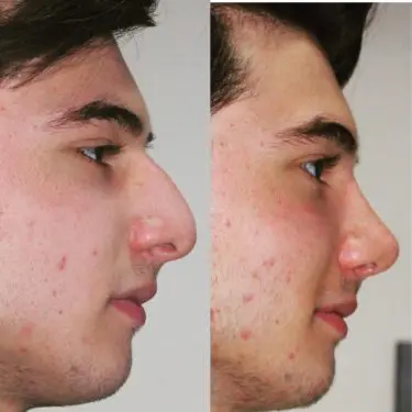 Rhinoplastik