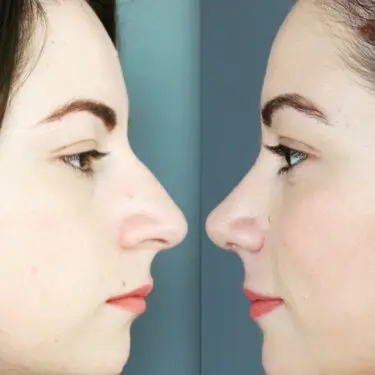 Rhinoplastik