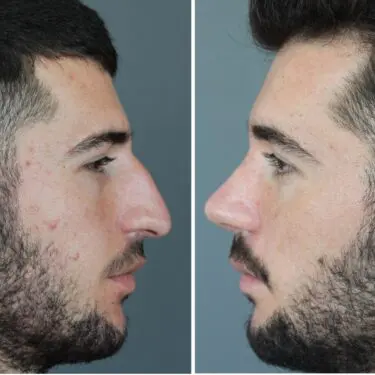 Rhinoplastik