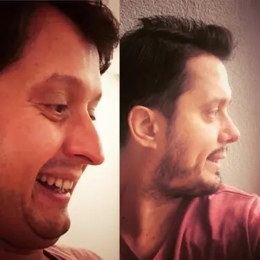 Rhinoplastik