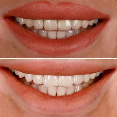 Veneers in der Türkei, Antalya