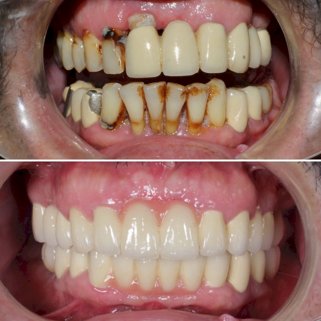 Имплантация зубов в Турции, Анталия