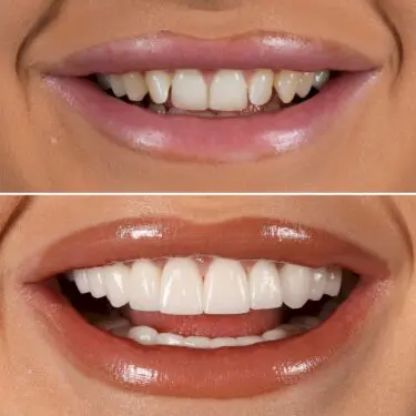 Veneers in der Türkei, Antalya