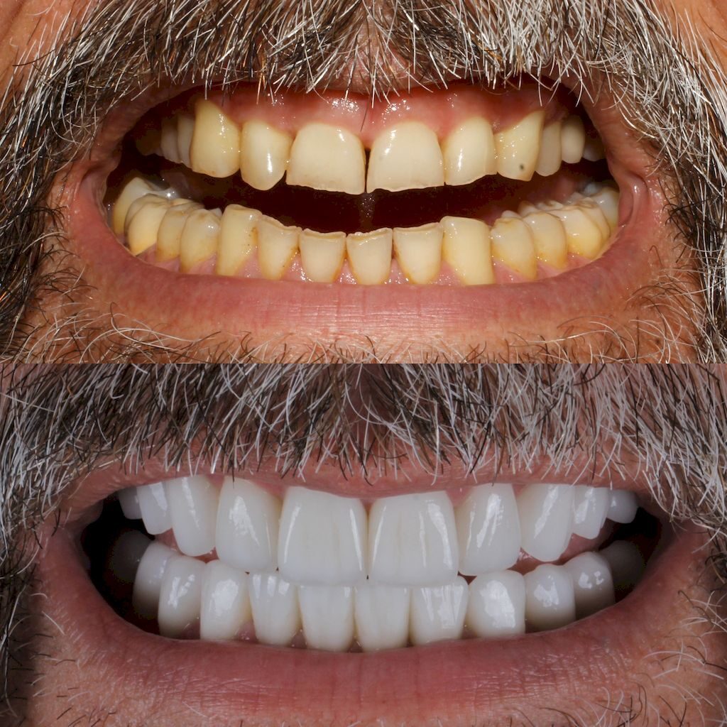 Імплантація зубів у Туреччині, Анталія